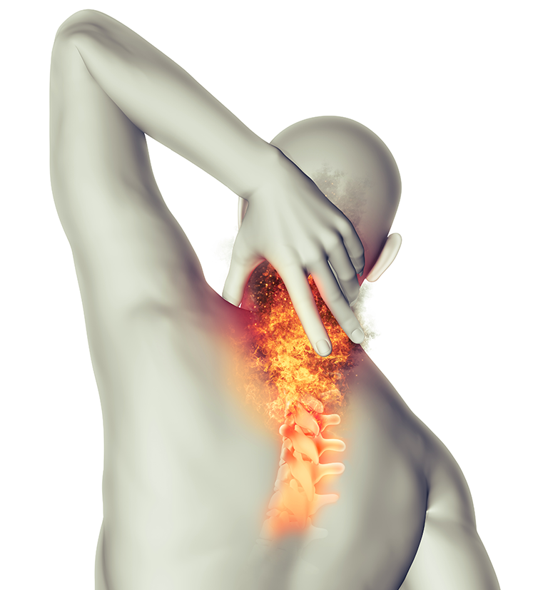 กระดูกทับเส้นประสาท Cervical